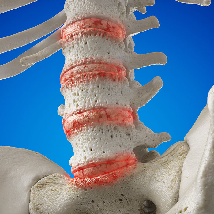 degenerative disc disease treatment in Tulsa OK