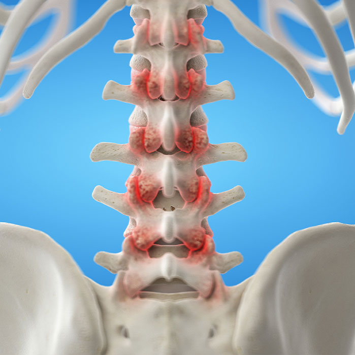 facet joint syndrome treatment in Tulsa OK