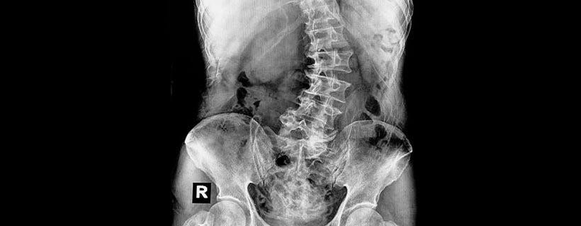 patient needing scoliosis treatment in Tulsa