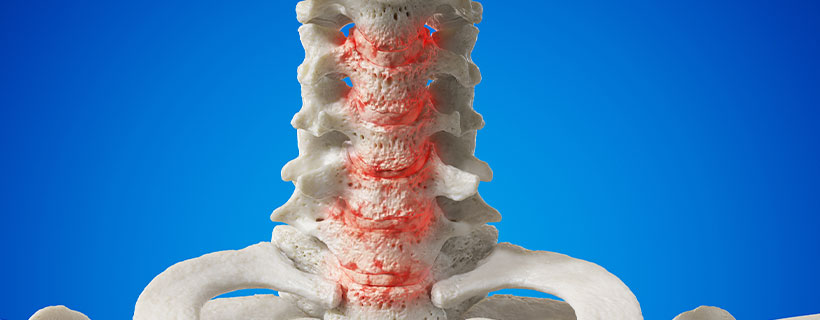 patient needing spondylosis treatment in Tulsa
