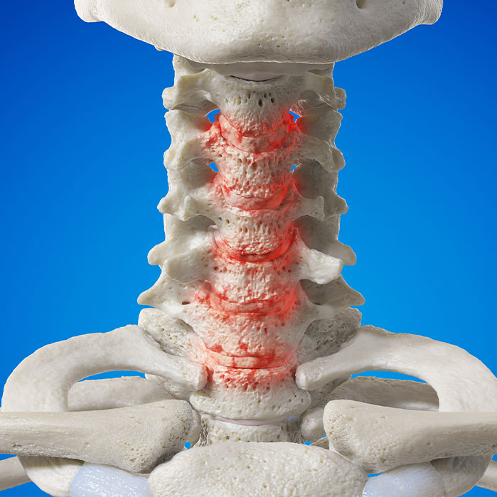 spondylosis treatment in Tulsa OK